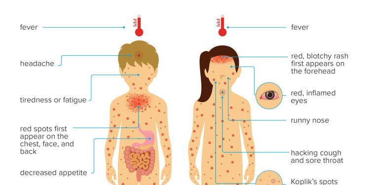 Measles Outbreak…  OVER 1,311,860 CHILDREN TO BE VACCINATED NATIONWIDE