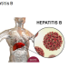 13.8% People Live with Hepatitis-B in Sierra Leone  – Dr. Sulaiman Lakkoh