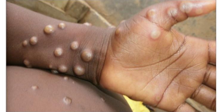 Guinea’s First Monkeypox Case Triggers Urgent Call for Sierra Leone to Intensify Health Measures