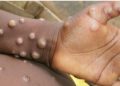 Guinea’s First Monkeypox Case Triggers Urgent Call for Sierra Leone to Intensify Health Measures