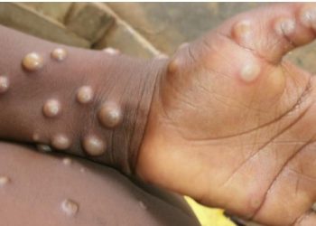 Guinea’s First Monkeypox Case Triggers Urgent Call for Sierra Leone to Intensify Health Measures