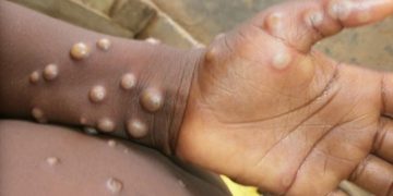 Guinea’s First Monkeypox Case Triggers Urgent Call for Sierra Leone to Intensify Health Measures