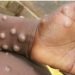 Guinea’s First Monkeypox Case Triggers Urgent Call for Sierra Leone to Intensify Health Measures