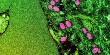 Skyrocketing Mpox Outbreak in Sierra Leone Raises Fears of wider spread